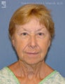 Facelift, Brow Lift & Eyelid Surgery