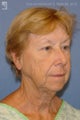 Facelift, Brow Lift & Eyelid Surgery