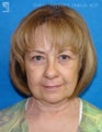 Facelift and Eyelid Surgery
