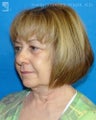 Facelift and Eyelid Surgery