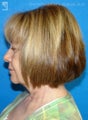 Facelift & Eyelid Surgery