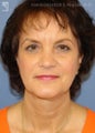 Facelift, Brow Lift & Eyelid Surgery