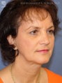Facelift, Brow Lift & Eyelid Surgery