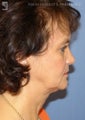 Facelift, Brow Lift & Eyelid Surgery