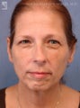 Facelift, Brow Lift, Eyelid Surgery & Chin Implant