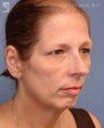 Facelift, Brow Lift, Eyelid Surgery & Chin Implant