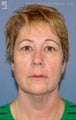 Facelift, Brow Lift & Eyelid Surgery