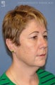 Facelift, Brow Lift & Eyelid Surgery