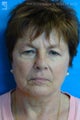 Facelift, Brow Lift & Eyelid Surgery