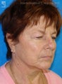 Facelift, Brow Lift & Eyelid Surgery