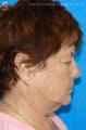 Facelift, Brow Lift & Eyelid Surgery
