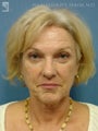 Facelift, Eyelid Surgery & Dermabrasion