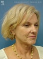 Facelift, Eyelid Surgery & Dermabrasion