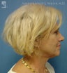 Facelift, Eyelid Surgery & Dermabrasion