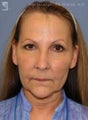 Facelift, Brow Lift & Eyelid Surgery