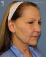 Facelift, Brow Lift & Eyelid Surgery