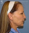 Facelift, Brow Lift & Eyelid Surgery
