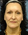 Facelift & Eyelid Surgery