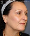 Facelift & Eyelid Surgery