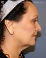 Facelift & Eyelid Surgery