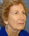 Facelift, Brow Lift & Eyelid Surgery