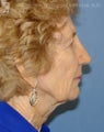 Facelift, Brow Lift & Eyelid Surgery