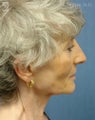 Facelift