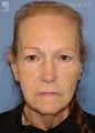 Facelift & Eyelid Surgery
