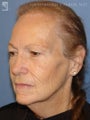 Facelift & Eyelid Surgery