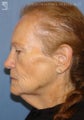 Facelift & Eyelid Surgery