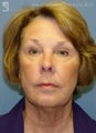 Facelift, Eyelid Surgery & Chin Implant