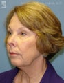 Facelift, Eyelid Surgery & Chin Implant