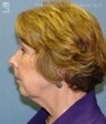 Facelift, Eyelid Surgery & Chin Implant
