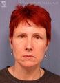 Facelift, Brow Lift & Lower Blepharoplasty