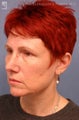 Facelift, Brow Lift & Lower Blephroplasty