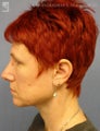 Facelift, Brow Lift & Lower Blepharoplasty