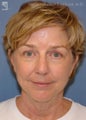 Facelift & Lower Blepharoplasty