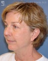 Facelift & Lower Blepharoplasty