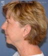 Facelift & Lower Blepharoplasty
