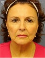 Facelift