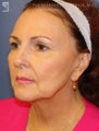Facelift