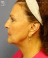 Facelift