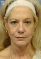 Facelift, Brow Lift & Eyelid Surgery