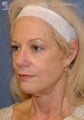 Facelift, Brow Lift & Eyelid Surgery