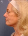 Facelift, Brow Lift & Eyelid Surgery