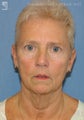 Facelift & Lower Blepharoplasty