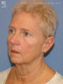 Facelift & Lower Blepharoplasty