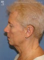 Facelift & Lower Blepharoplasty