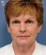 Facelift, Brow Lift & Lower Blepharoplasty