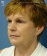 Facelift, Brow Lift & Lower Blepharoplasty